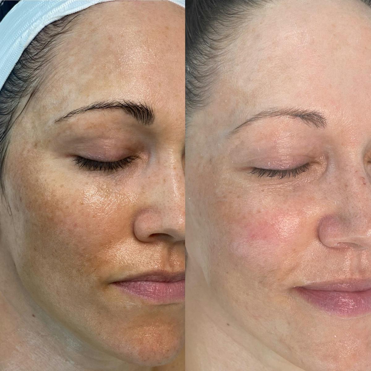 Lasers Before & After Gallery - Patient 354181 - Image 1