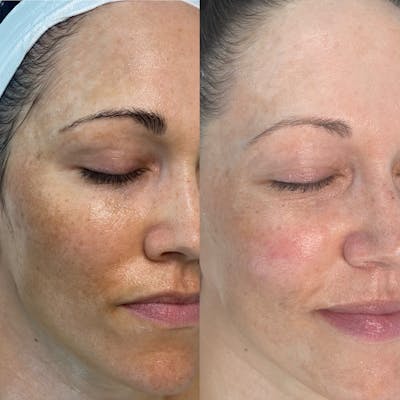 Lasers Before & After Gallery - Patient 354181 - Image 1