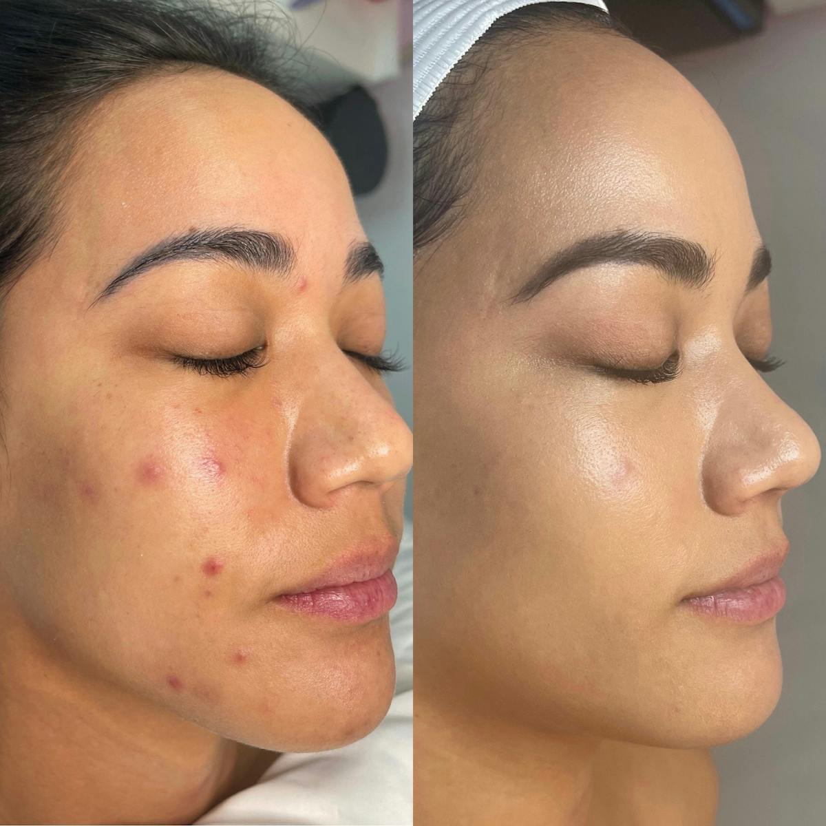 Lasers Before & After Gallery - Patient 104203 - Image 1
