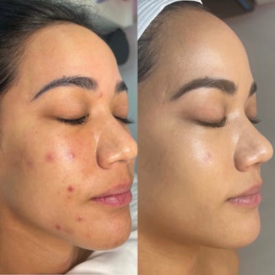 Lasers Before & After Gallery - Patient 104203 - Image 1