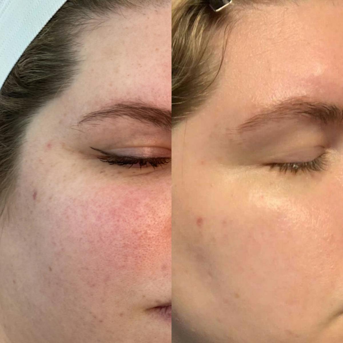 Lasers Before & After Gallery - Patient 419381 - Image 1