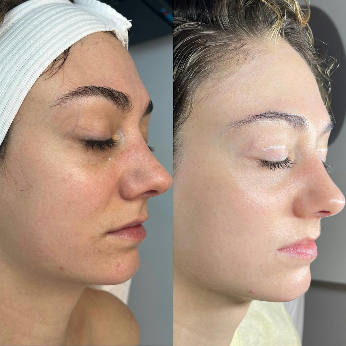 Lasers Before & After Gallery - Patient 240019 - Image 1