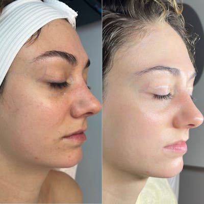 Lasers Before & After Gallery - Patient 240019 - Image 1