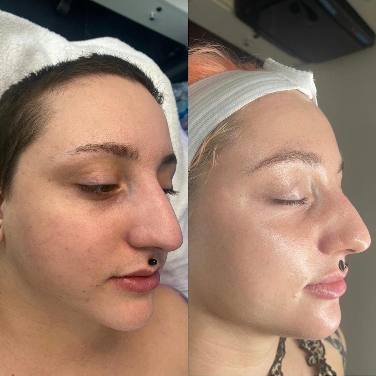 Lasers Before & After Gallery - Patient 344787 - Image 1