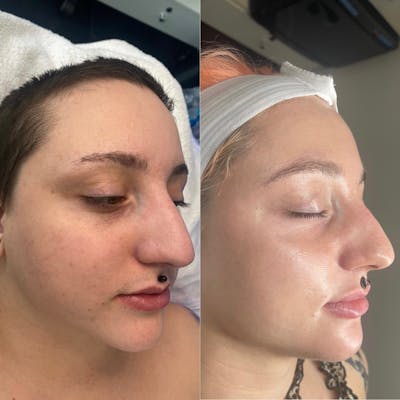 Lasers Before & After Gallery - Patient 344787 - Image 1