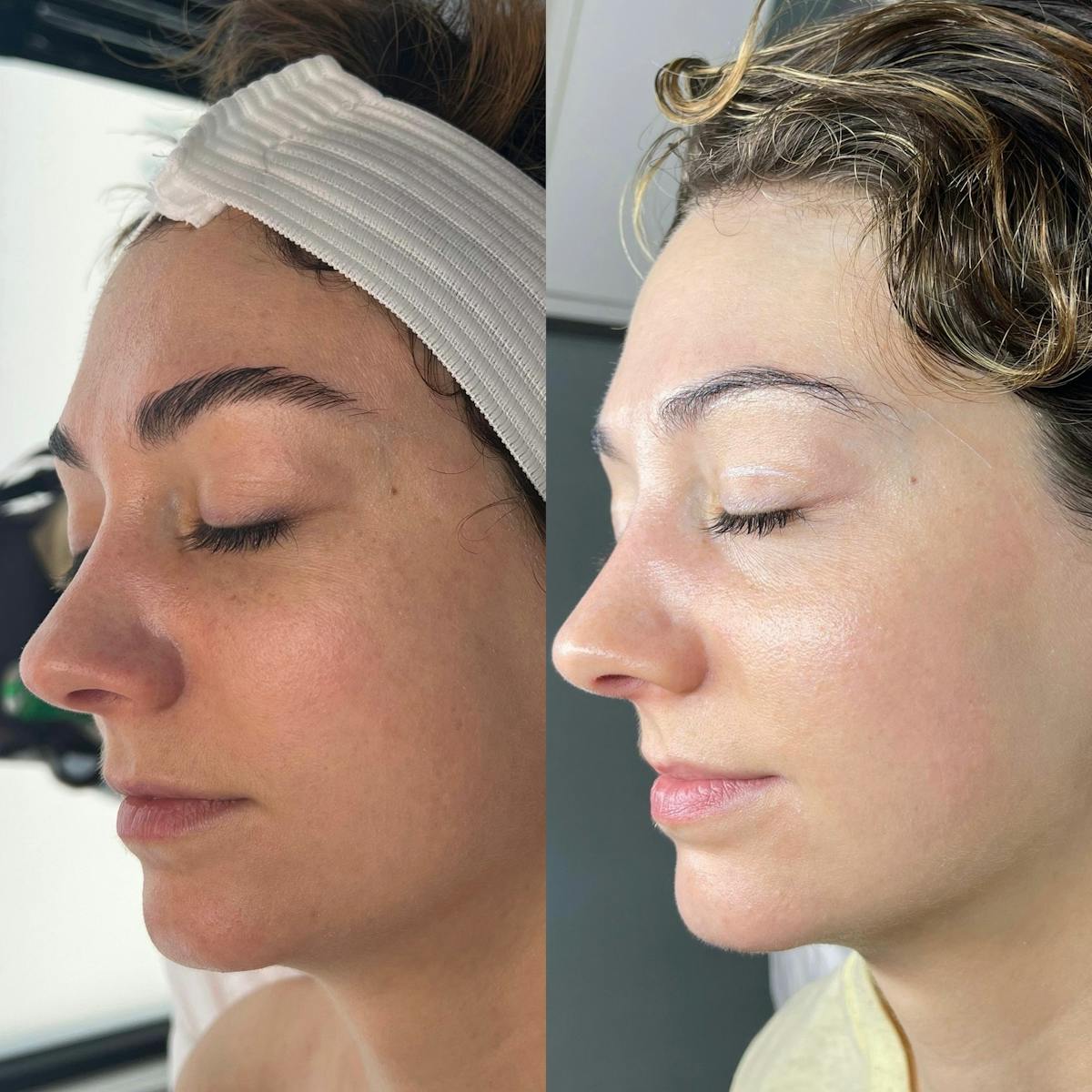 Lasers Before & After Gallery - Patient 114479 - Image 1