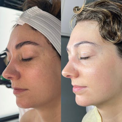 Lasers Before & After Gallery - Patient 114479 - Image 1