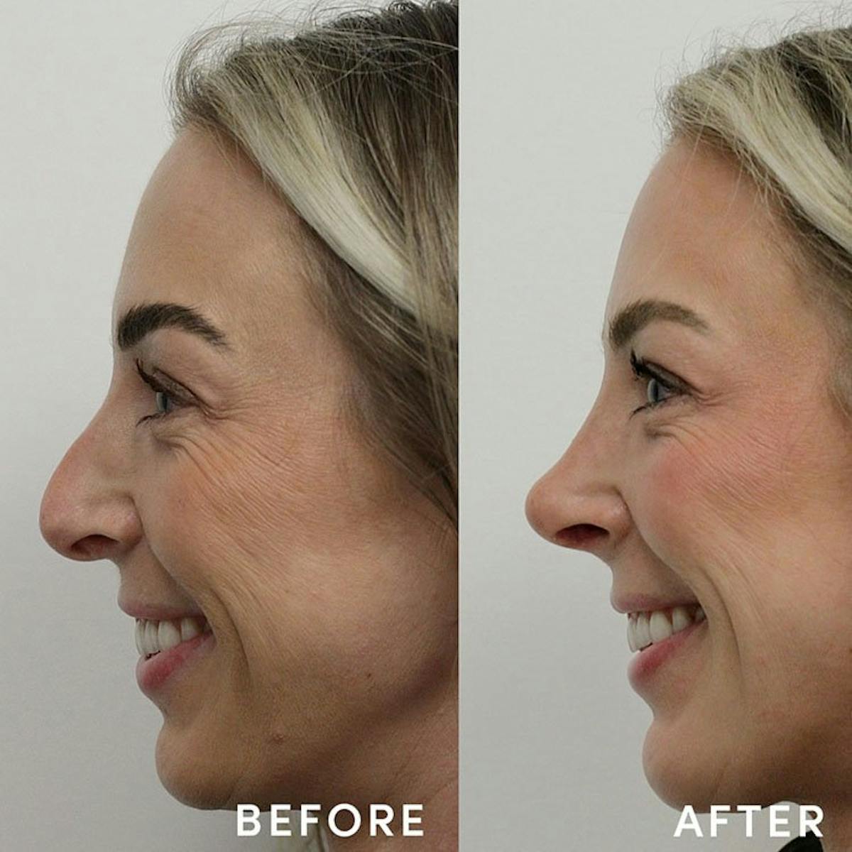 Rhinoplasty Before & After Gallery - Patient 327982 - Image 3