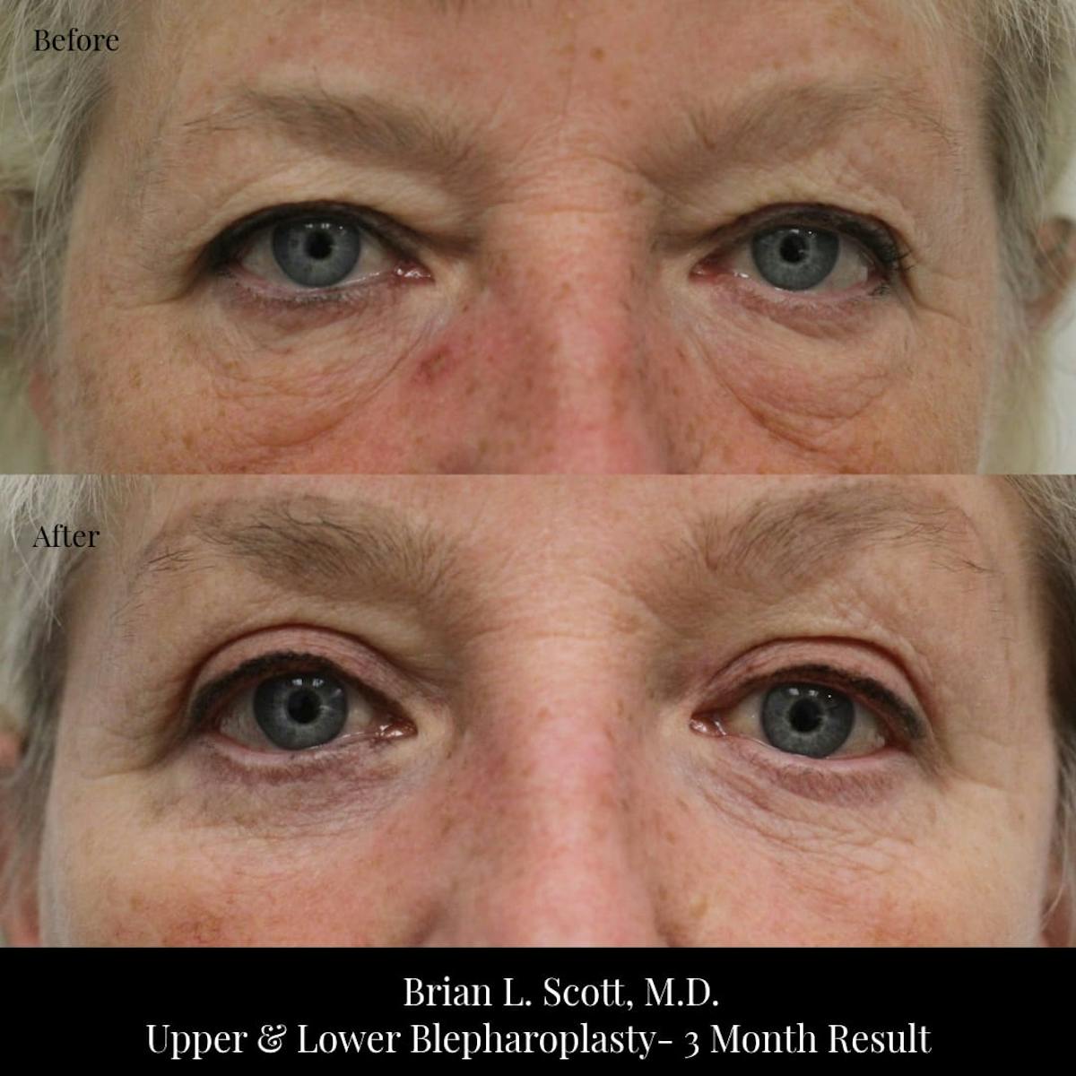 Facelift Before & After Gallery - Patient 426561 - Image 1