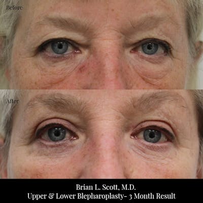 Facelift Before & After Gallery - Patient 426561 - Image 1