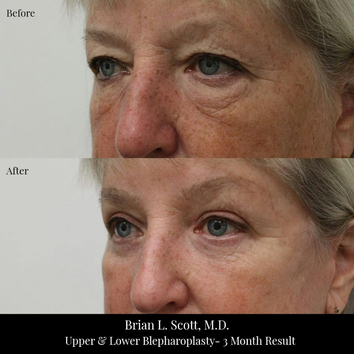 Facelift Before & After Gallery - Patient 426561 - Image 2