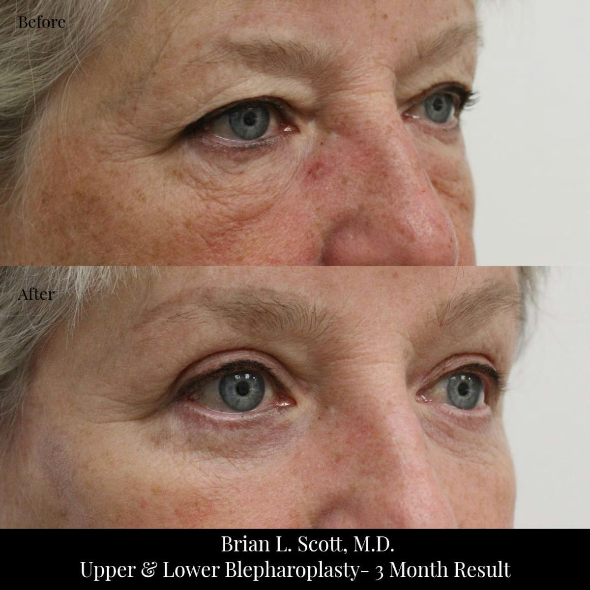 Facelift Before & After Gallery - Patient 426561 - Image 3