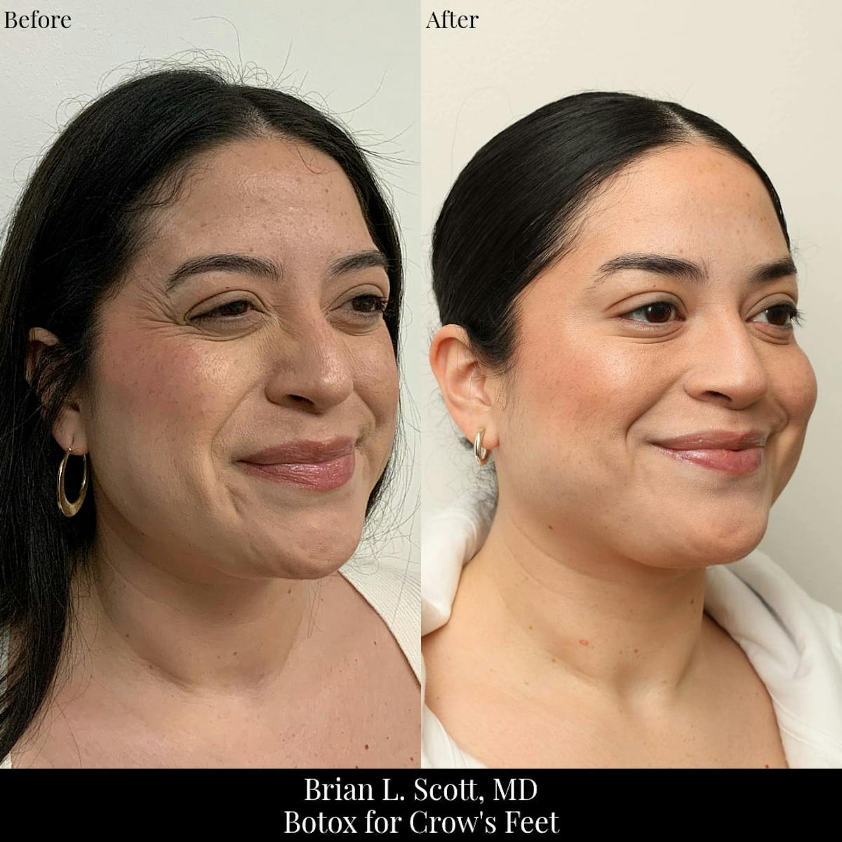 BOTOX Before & After Gallery - Patient 966739 - Image 2