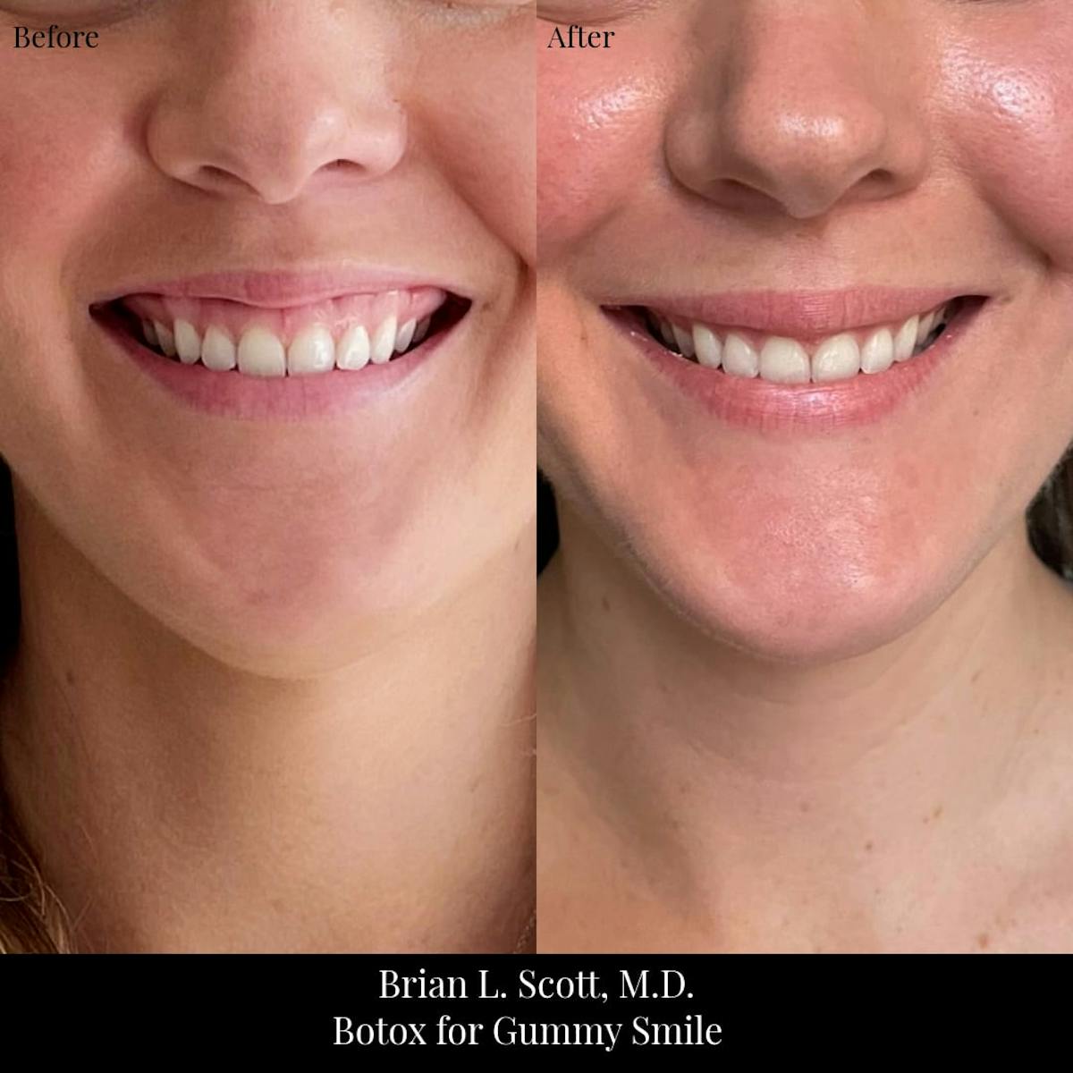 BOTOX Before & After Gallery - Patient 277295 - Image 1
