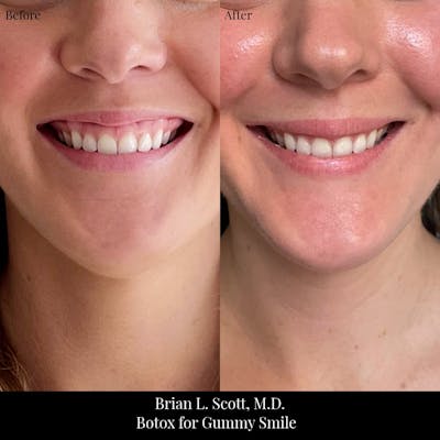 BOTOX Before & After Gallery - Patient 277295 - Image 1