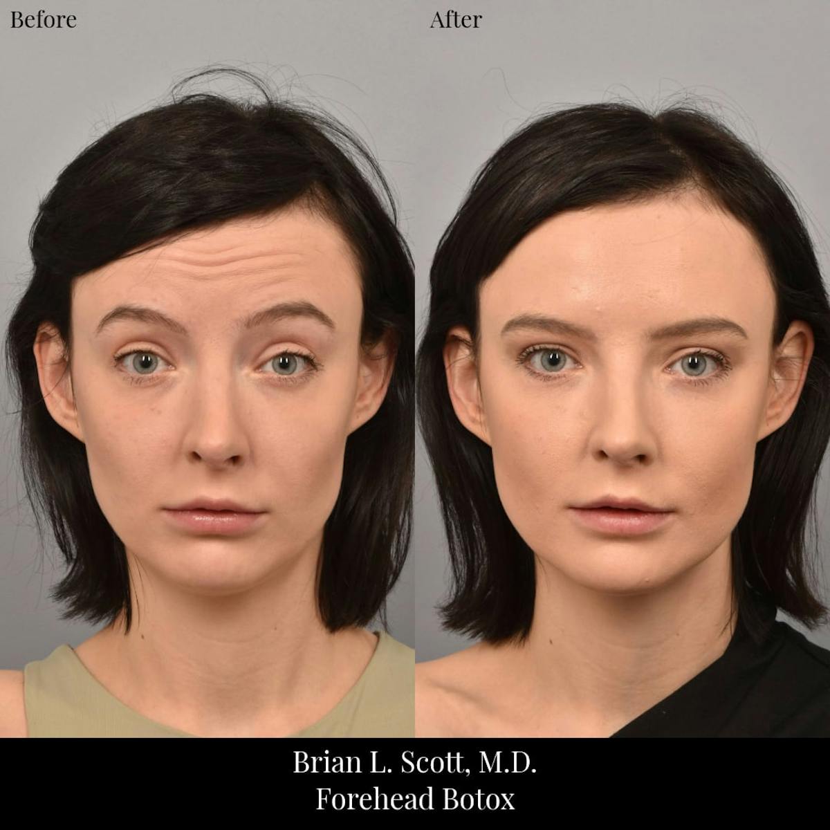 BOTOX Before & After Gallery - Patient 168143 - Image 2