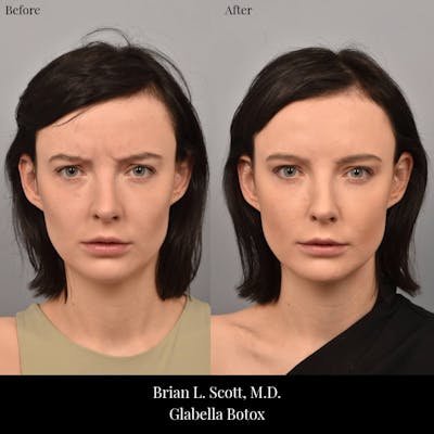 BOTOX Before & After Gallery - Patient 168143 - Image 1