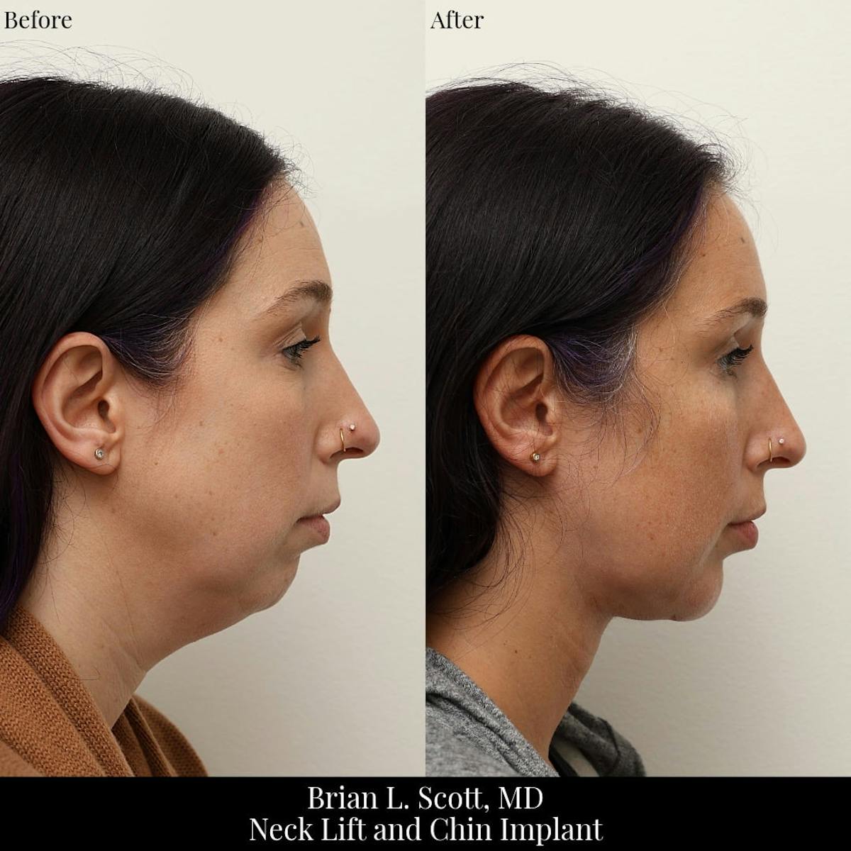 Neck Lift Before & After Gallery - Patient 204977 - Image 2