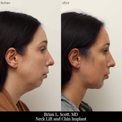 Chin and Neck Liposuction Before & After Gallery - Patient 109735 - Image 1