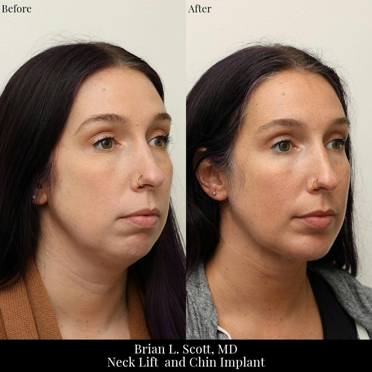 Neck Liposuction Before & After Gallery - Patient 175879 - Image 2