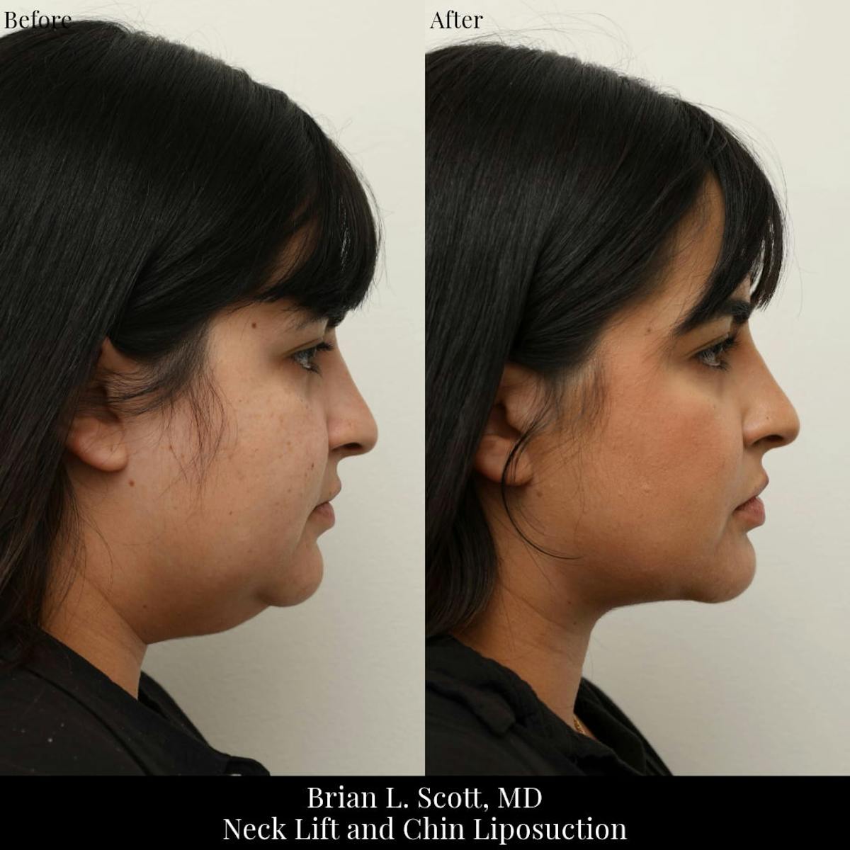 Neck Liposuction Before & After Gallery - Patient 696562 - Image 1