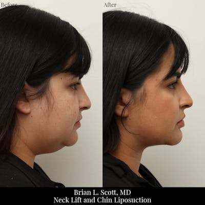 Chin and Neck Liposuction Before & After Gallery - Patient 209671 - Image 1