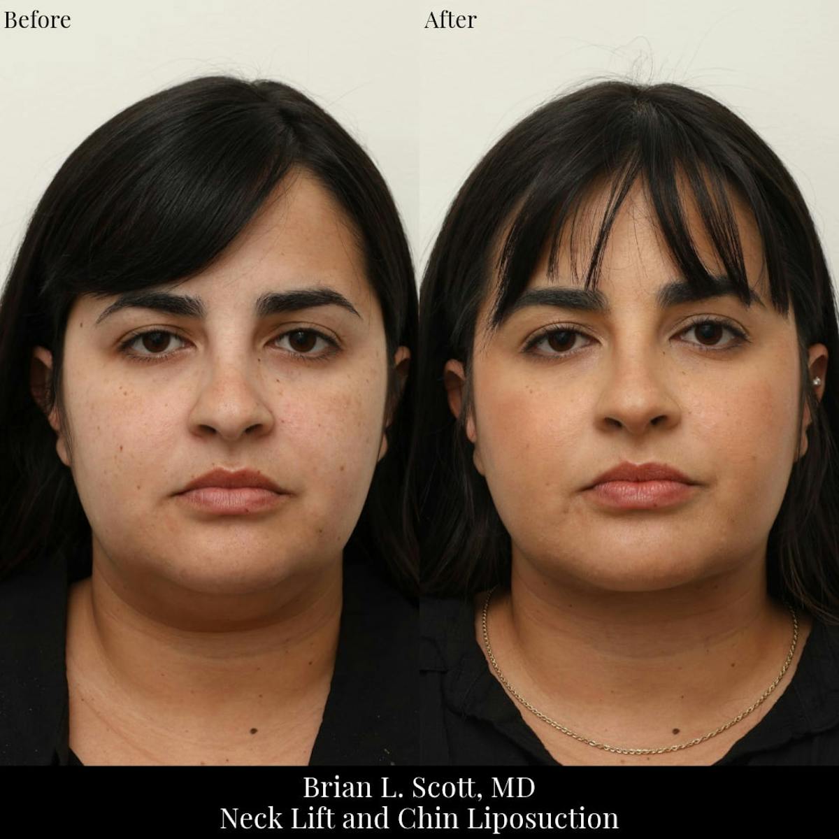 Neck Liposuction Before & After Gallery - Patient 696562 - Image 2