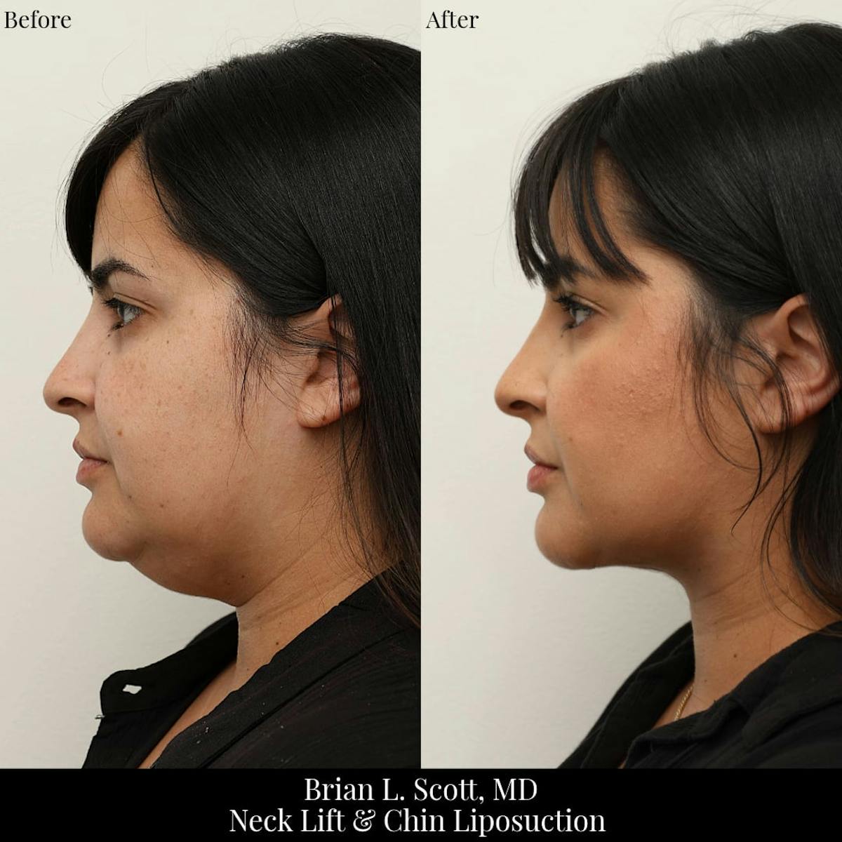 Neck Liposuction Before & After Gallery - Patient 696562 - Image 3