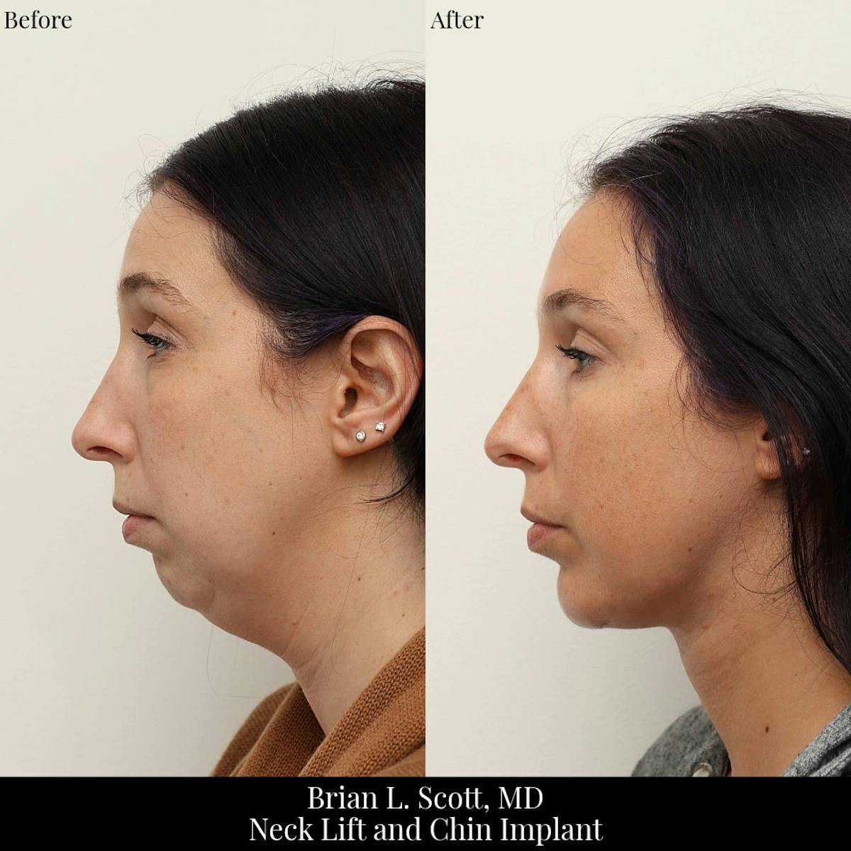 Neck Lift Before & After Gallery - Patient 204977 - Image 3