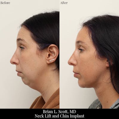 Chin Augmentation Before & After Gallery - Patient 118775 - Image 1