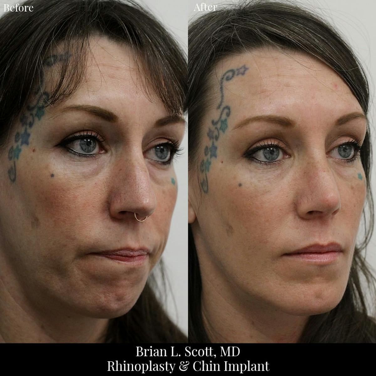Rhinoplasty Before & After Gallery - Patient 761719 - Image 3