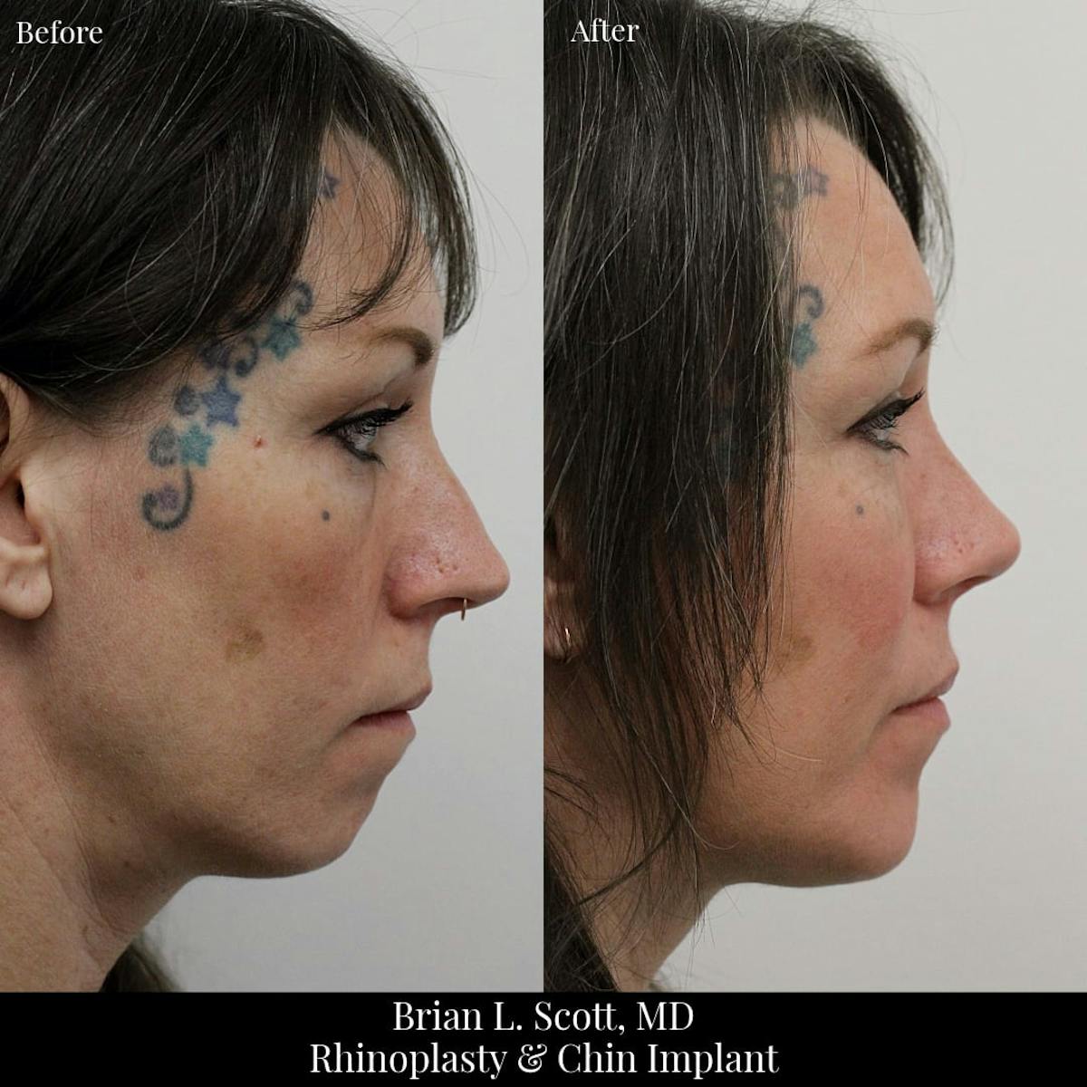 Chin Augmentation Before & After Gallery - Patient 323708 - Image 1
