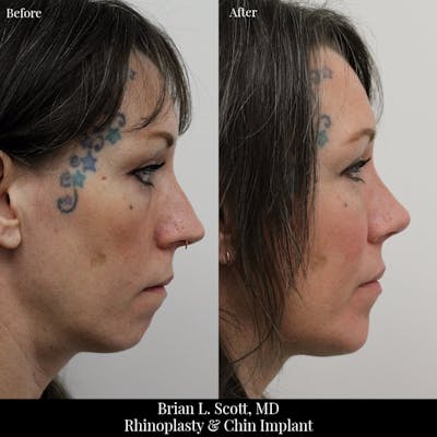 Chin Augmentation Before & After Gallery - Patient 323708 - Image 1