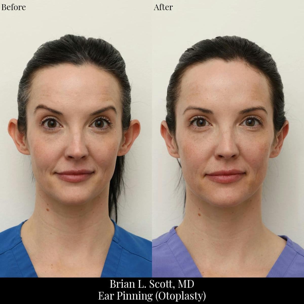 Ear Pinning (Otoplasty) Before & After Gallery - Patient 320763 - Image 1