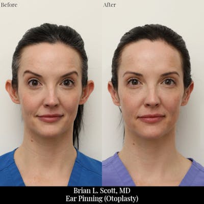 Ear Pinning (Otoplasty) Before & After Gallery - Patient 320763 - Image 1