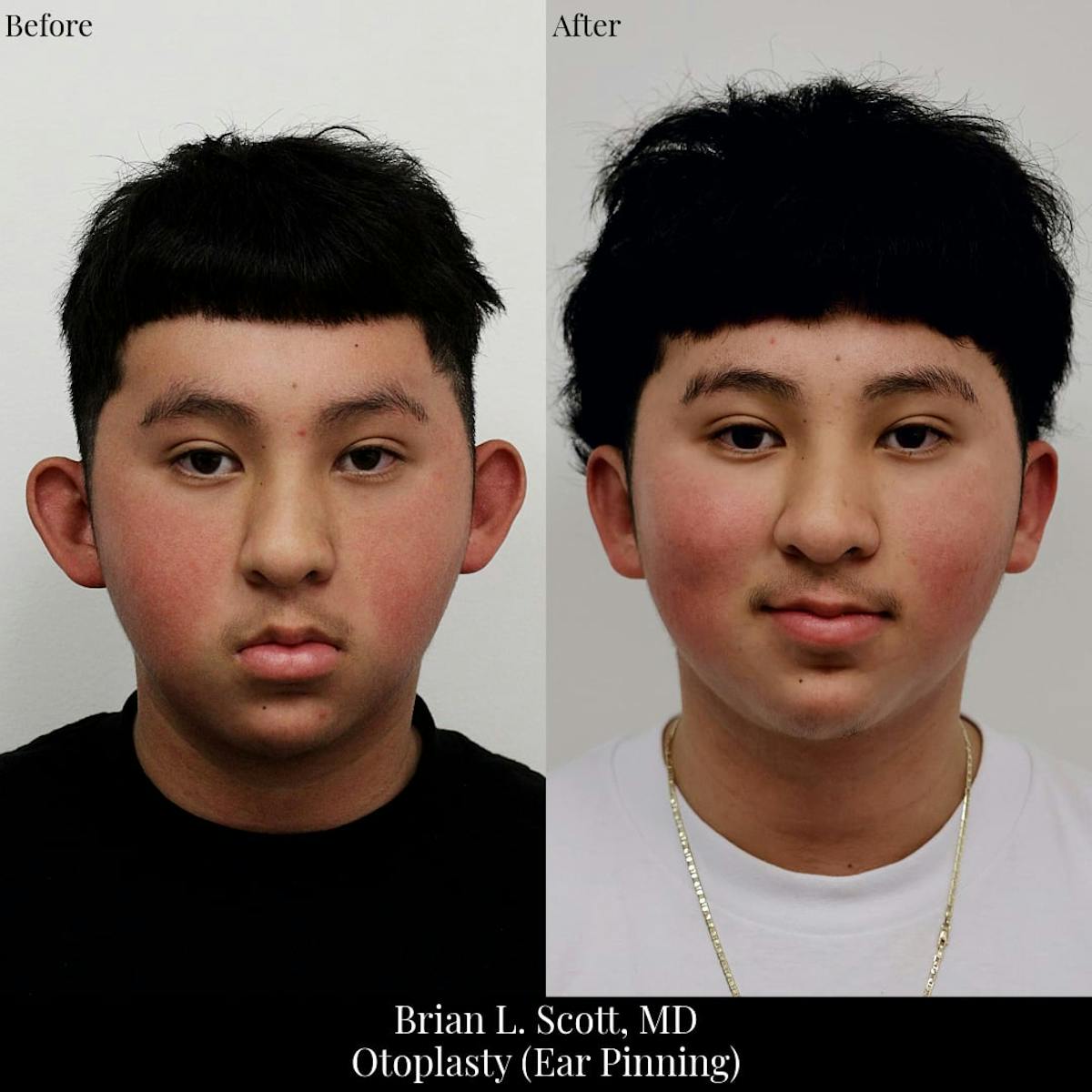 Ear Pinning (Otoplasty) Before & After Gallery - Patient 220329 - Image 1