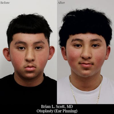Ear Pinning (Otoplasty) Before & After Gallery - Patient 220329 - Image 1