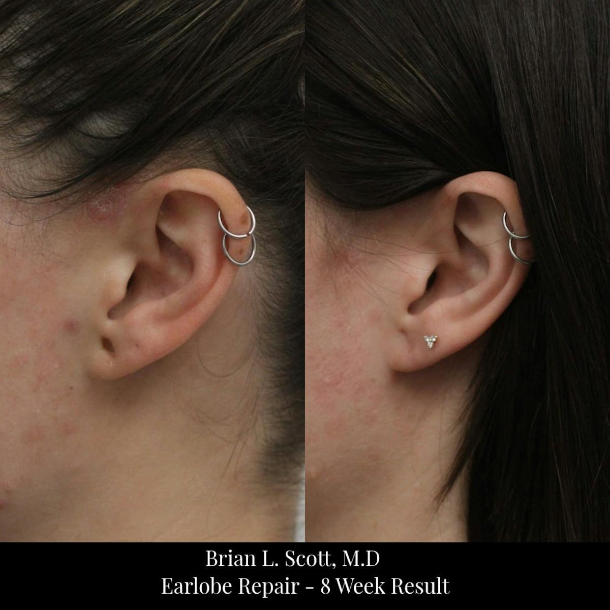 Earlobe Repair Before & After Gallery - Patient 330932 - Image 1