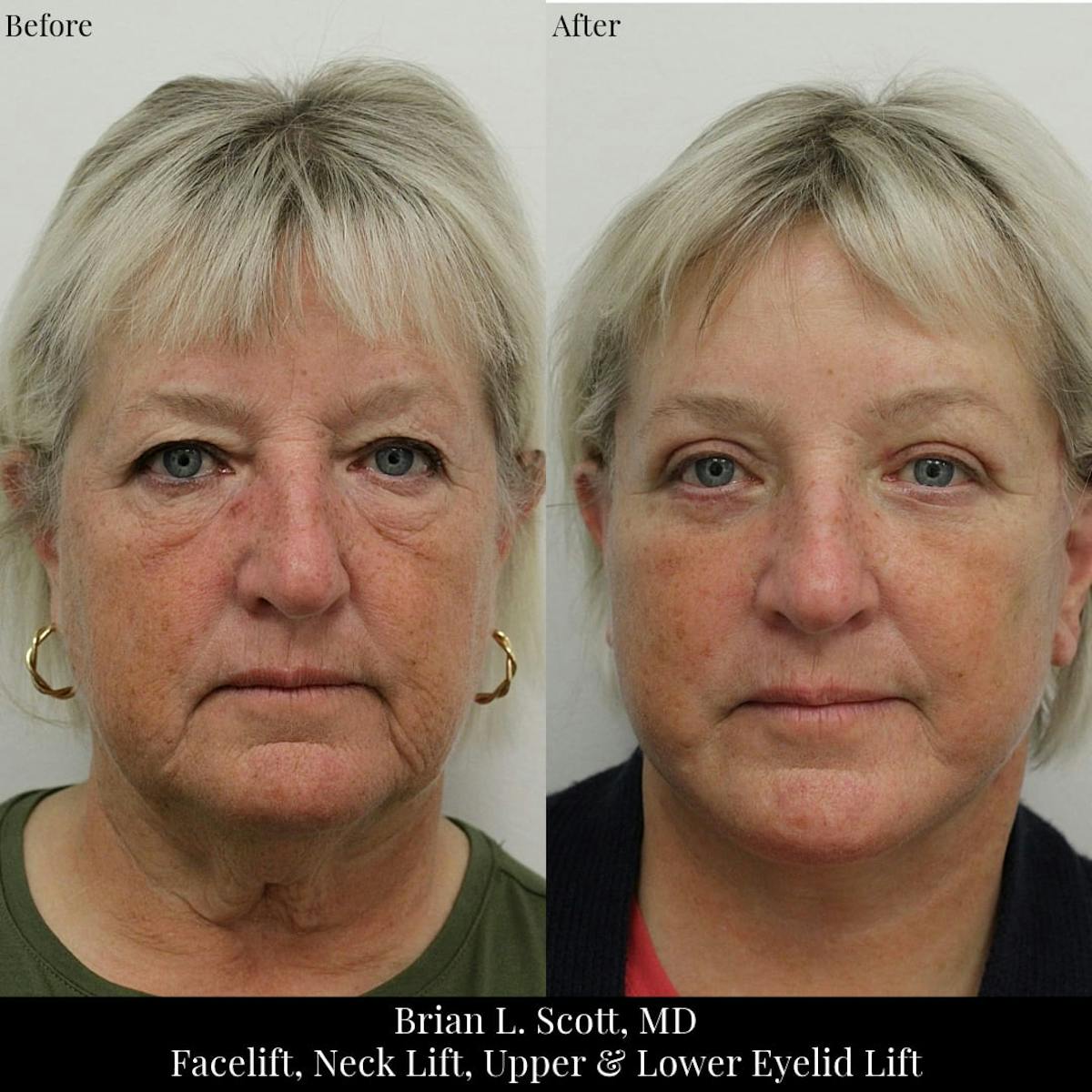 Neck Lift Before & After Gallery - Patient 736884 - Image 1