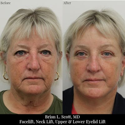 Facelift Before & After Gallery - Patient 330938 - Image 1