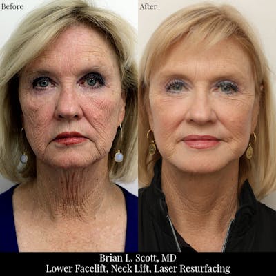 Facelift Before & After Gallery - Patient 421136 - Image 1