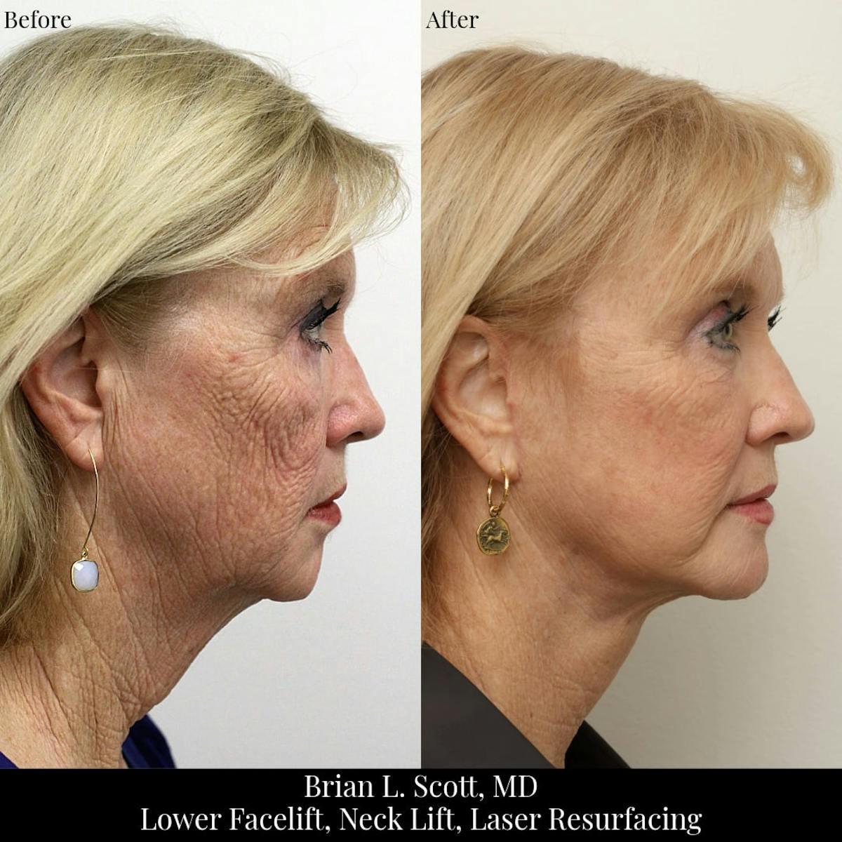 Neck Lift Before & After Gallery - Patient 256345 - Image 3