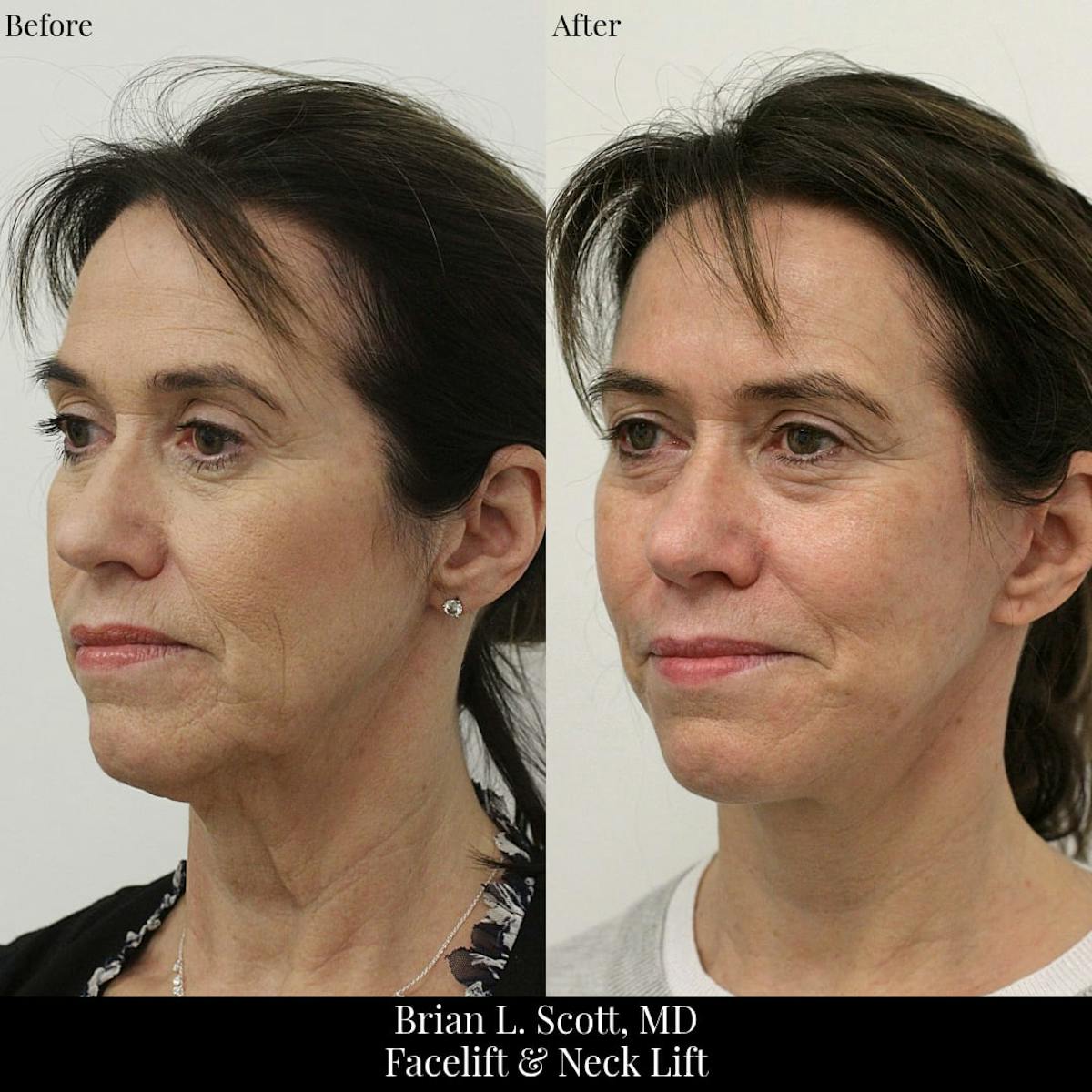 Facelift Before & After Gallery - Patient 168027 - Image 2