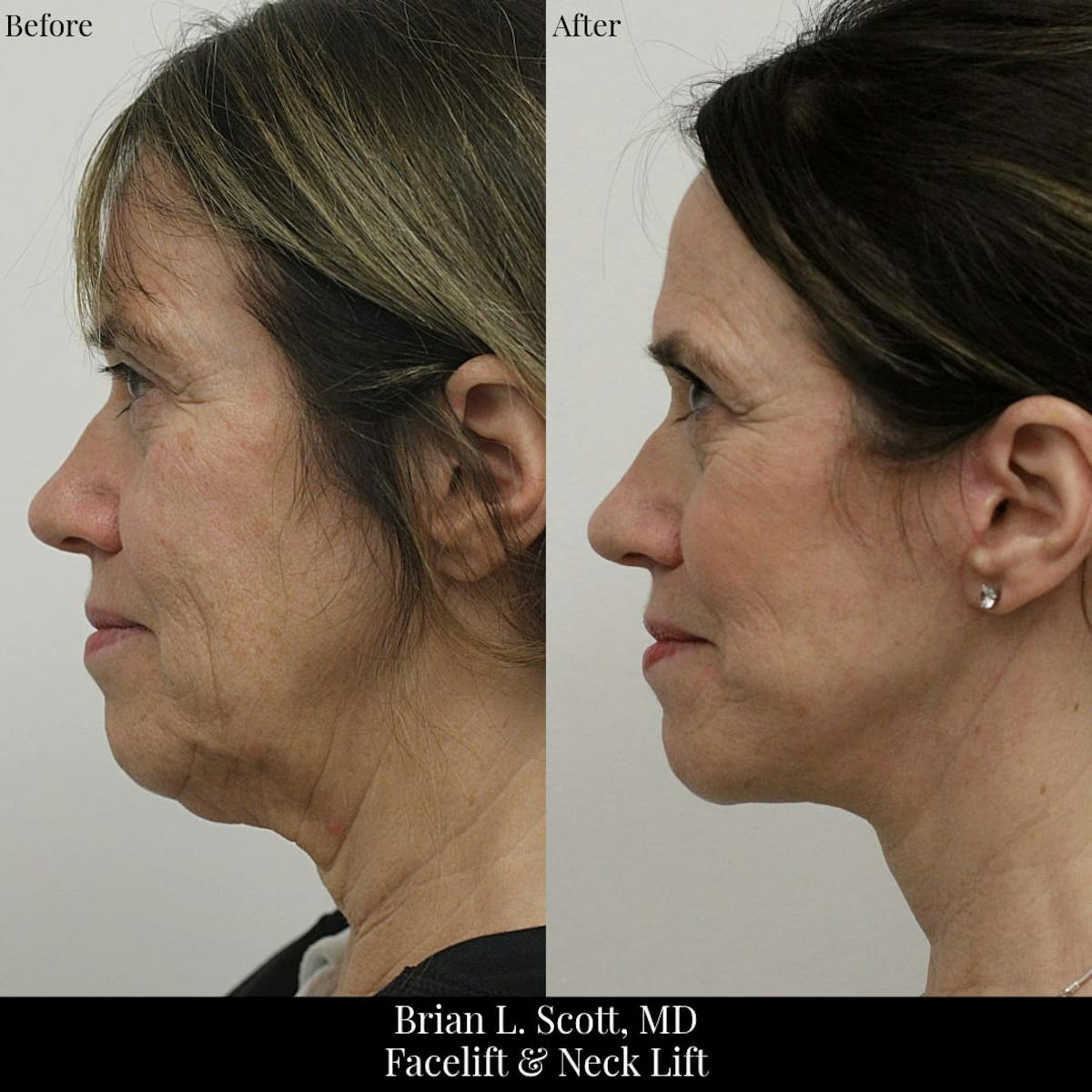 Facelift Before & After Gallery - Patient 168027 - Image 3