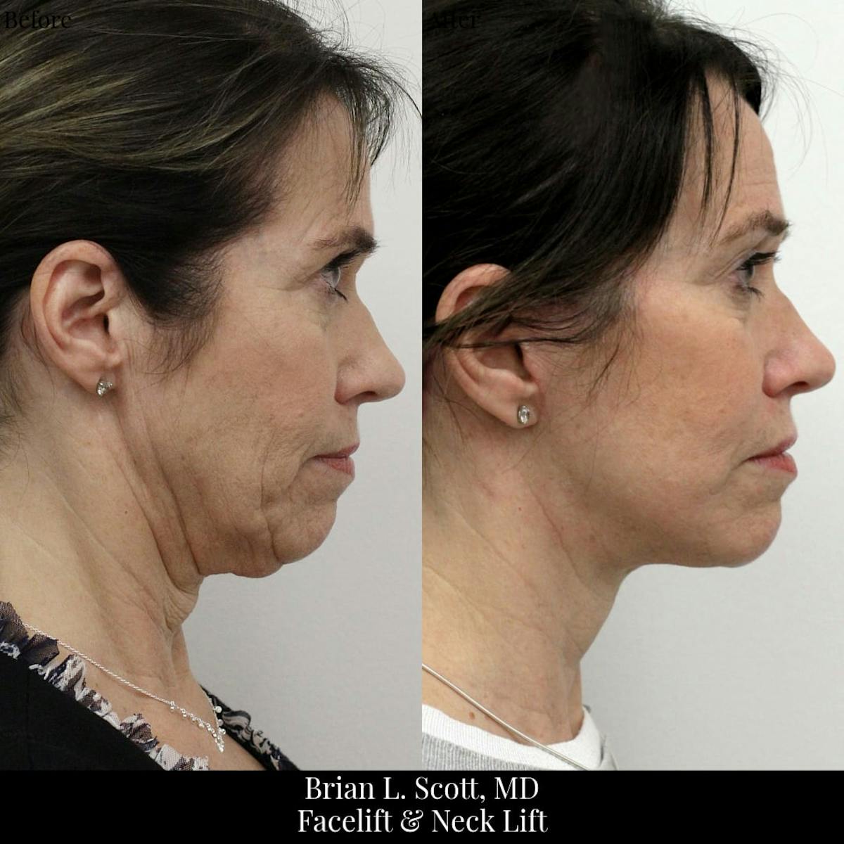 Neck Lift Before & After Gallery - Patient 364469 - Image 2