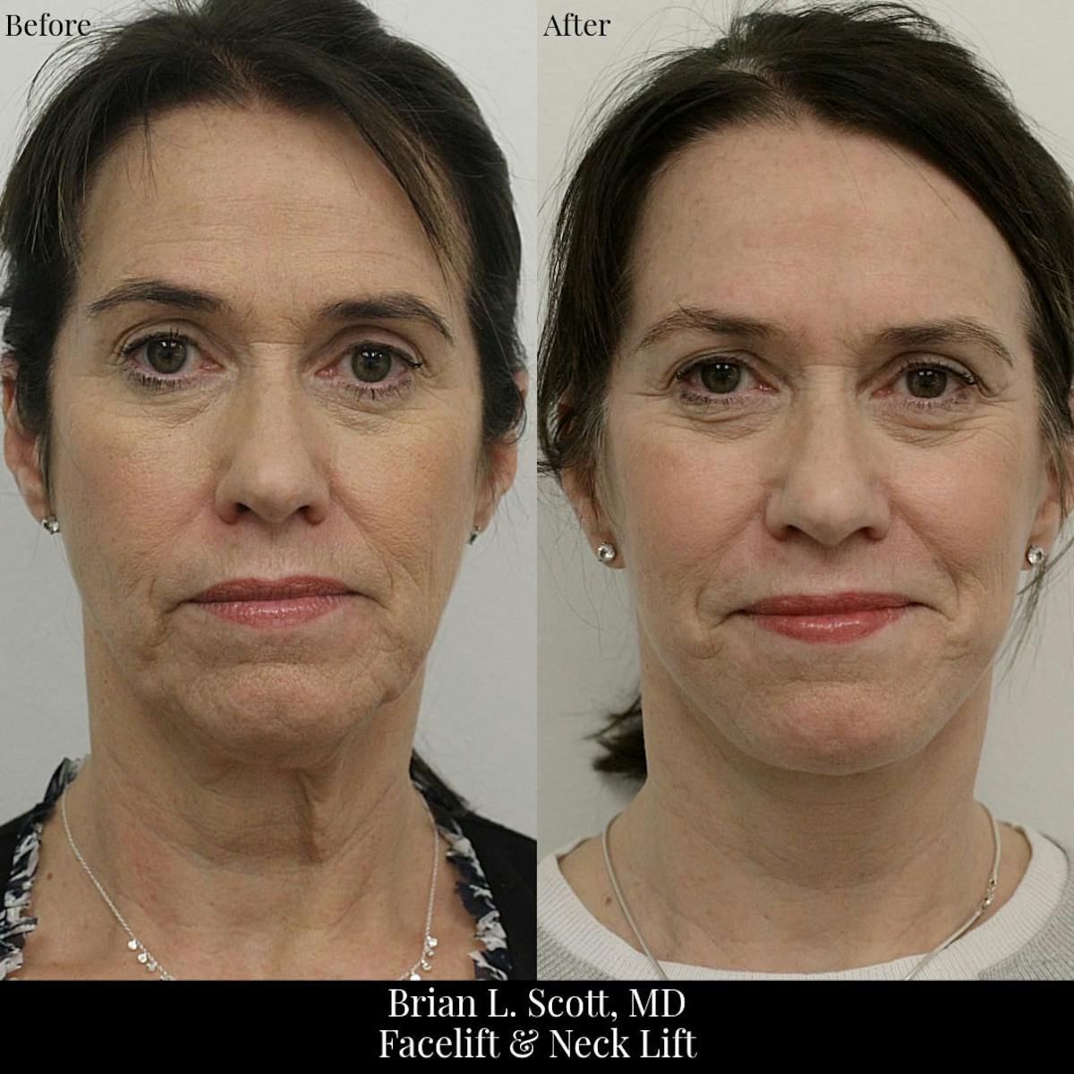 Neck Lift Before & After Gallery - Patient 364469 - Image 1