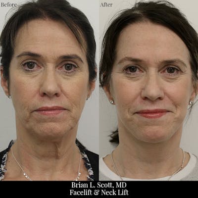 Facelift Before & After Gallery - Patient 168027 - Image 1