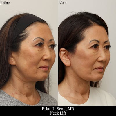 Facelift Before & After Gallery - Patient 896609 - Image 1