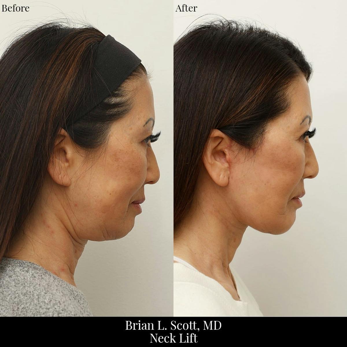 Facelift Before & After Gallery - Patient 896609 - Image 2