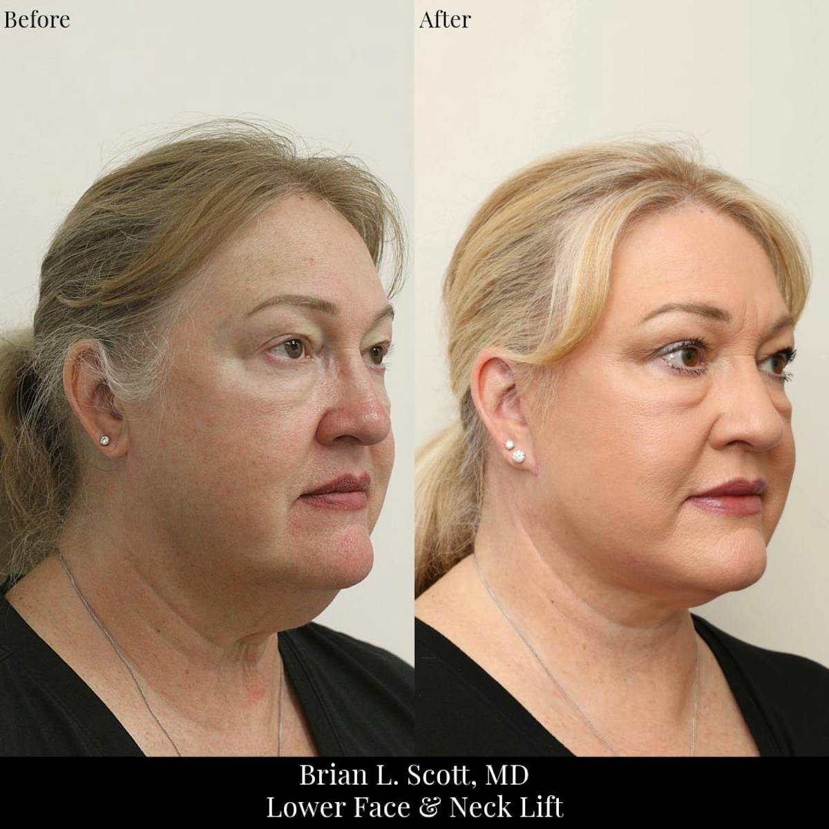 Facelift Before & After Gallery - Patient 427752 - Image 2